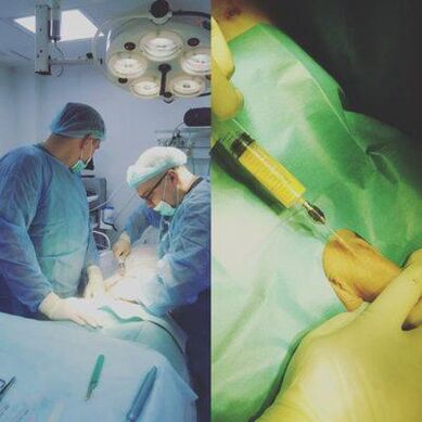 Потовщення члена можливе за допомогою хірургічного втручання